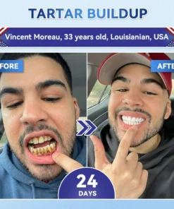 Glimmerly® Tooth & Gum Repair Clinical-Grade Microneedle Patches